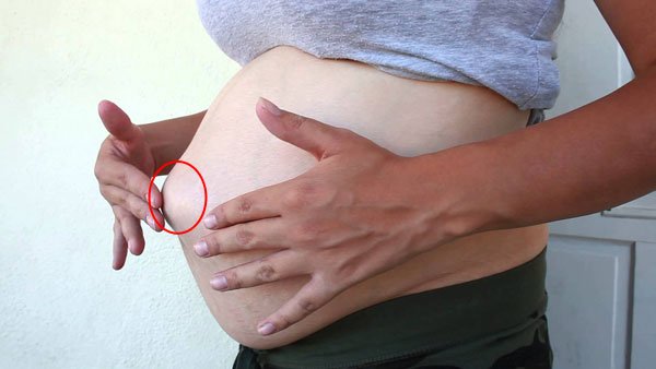 пупочная грыжа у беременных