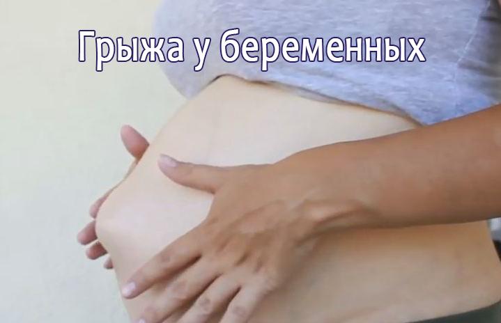 Симптомы грыжи у беременных